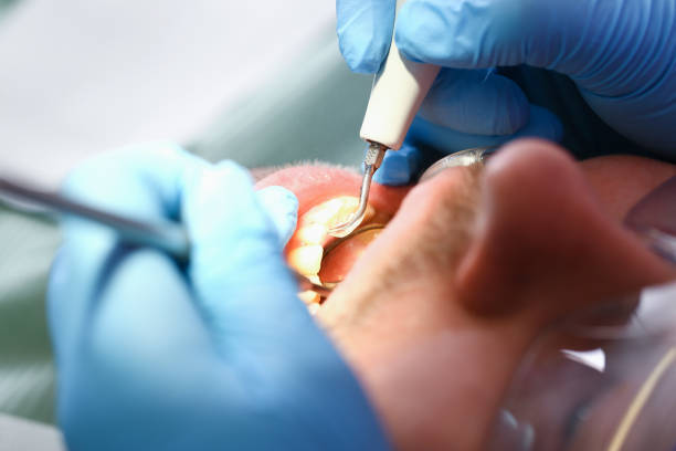 Best Emergency Wisdom Tooth Extraction in Hartford, KY