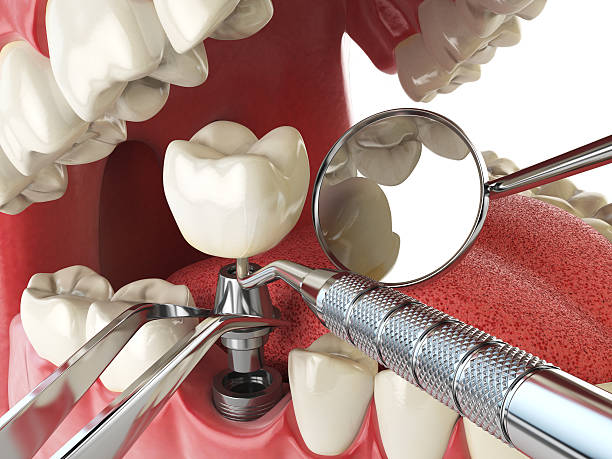 Best Knocked-Out Tooth (Avulsed Tooth) Treatment in Hartford, KY